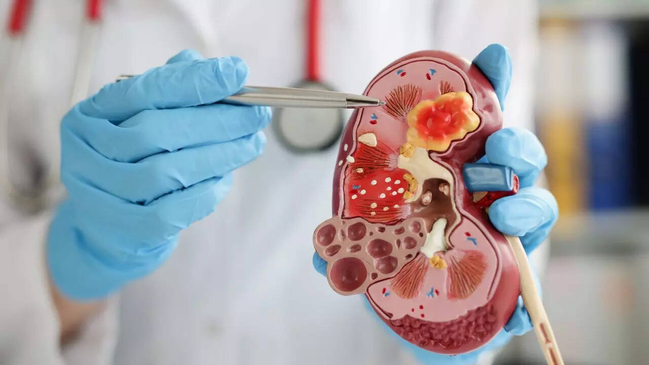 Kidney cancer