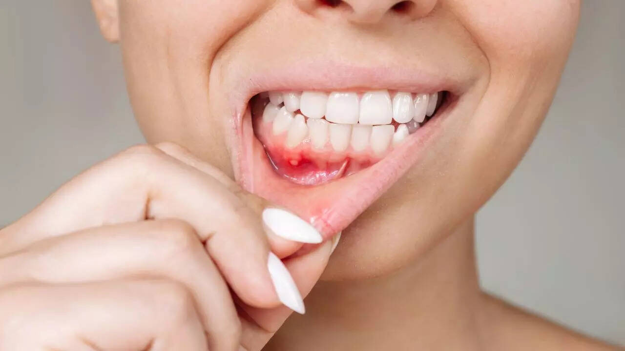 Bleeding gums