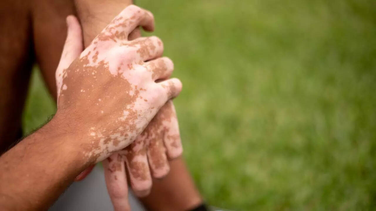 What is Vitiligo