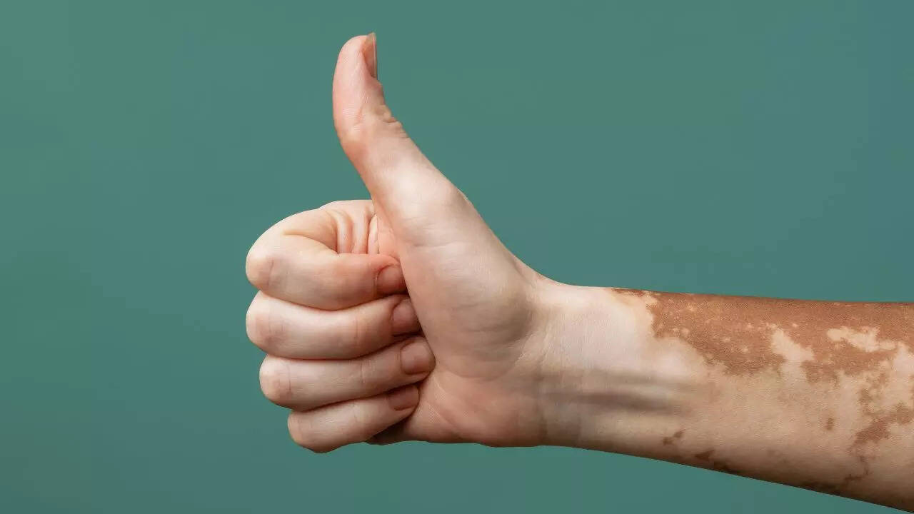 Why psychological support is essential in Vitiligo treatment