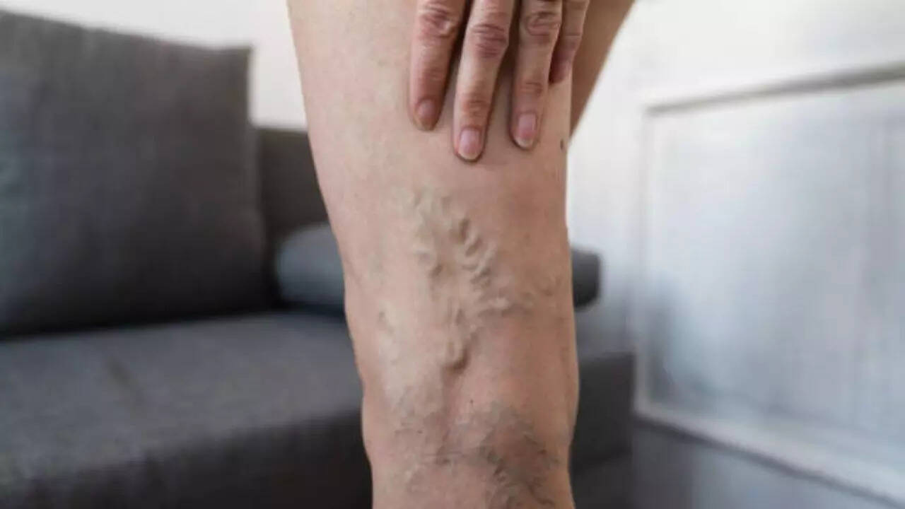 Chronic Vein Insufficiency (CVI) or Varicose Veins