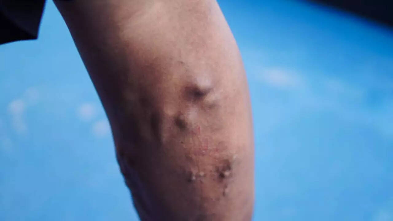 Deep Vein Thrombosis (DVT)