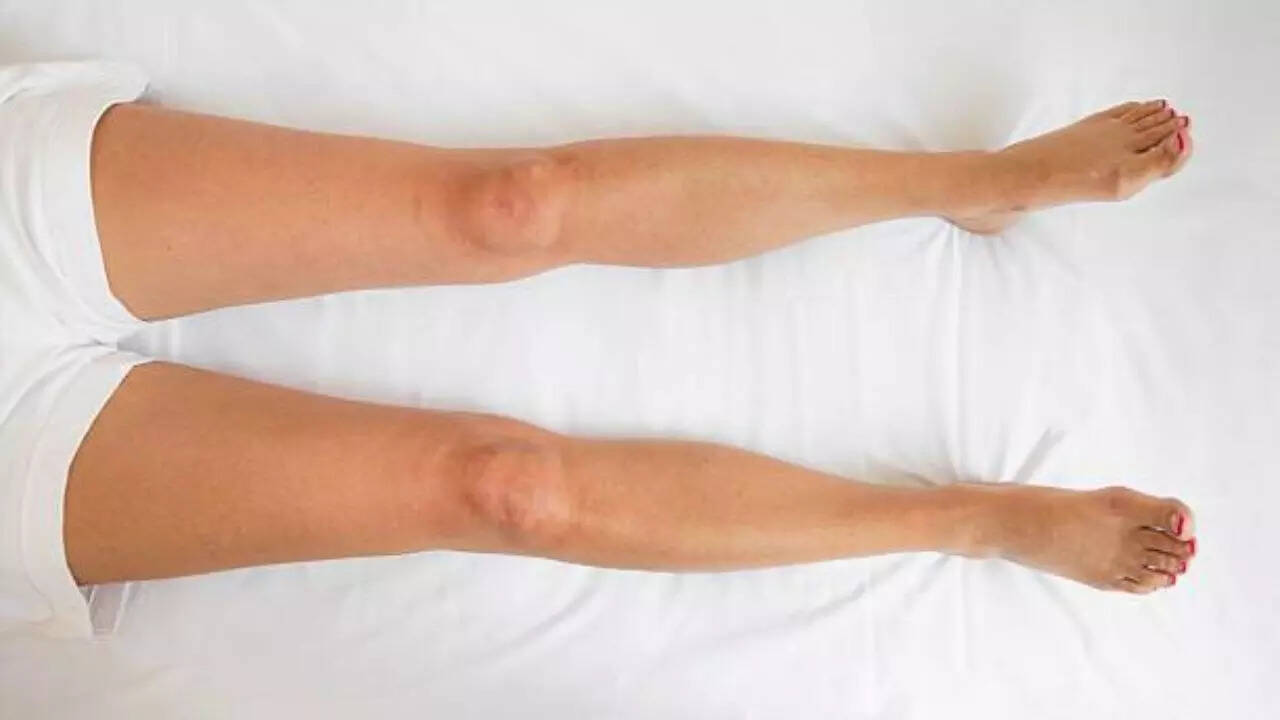Lymphedema