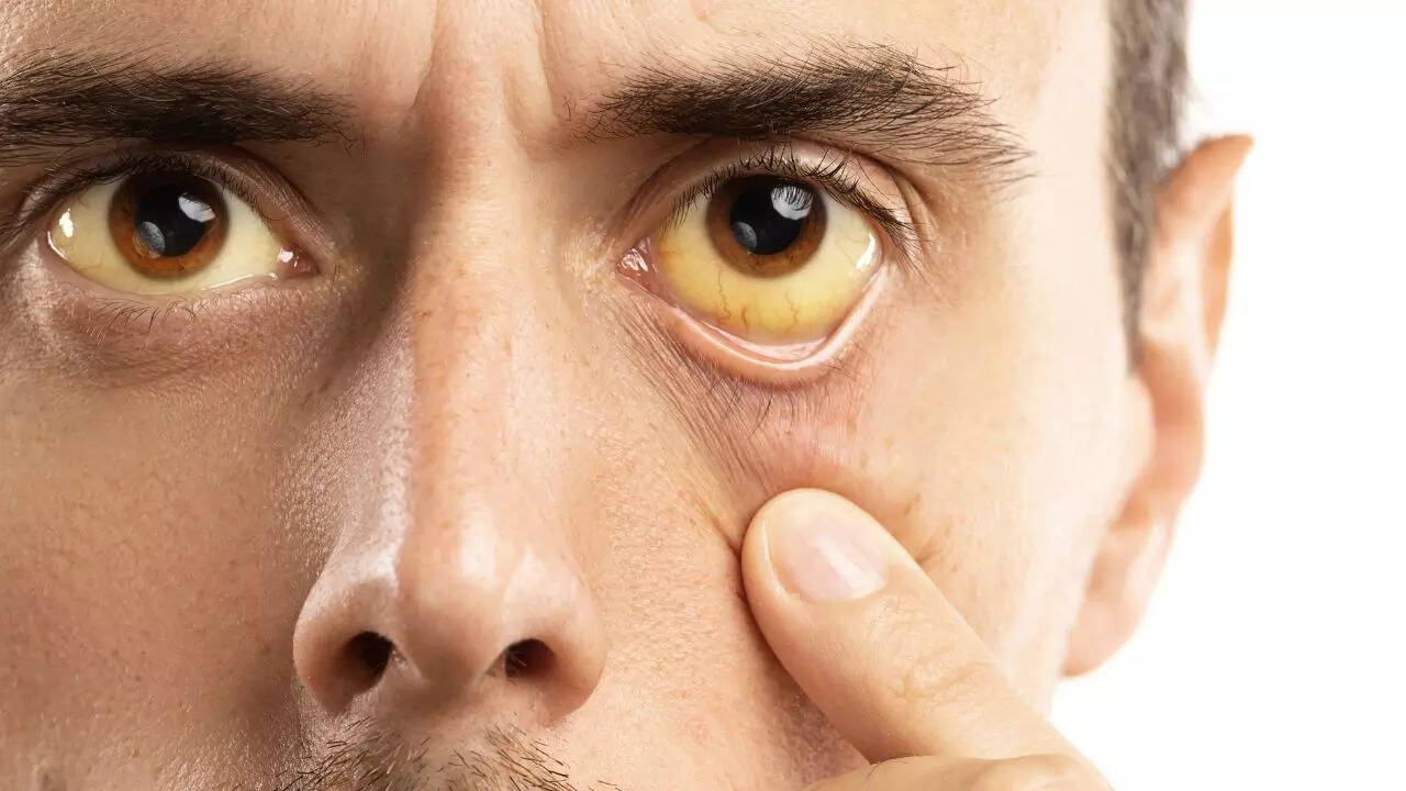 Jaundice