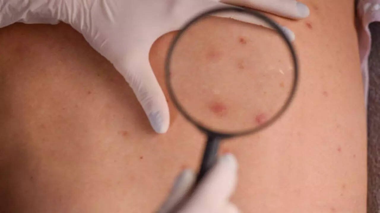 All about squamous cell carcinoma