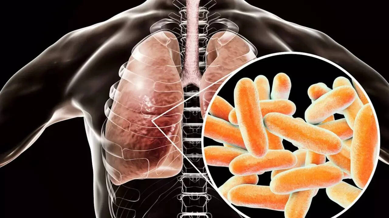 Legionnaires’ disease (1)