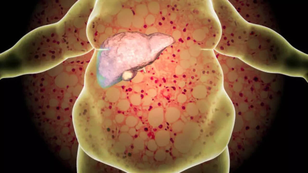 What are the three symptoms of fatty liver?