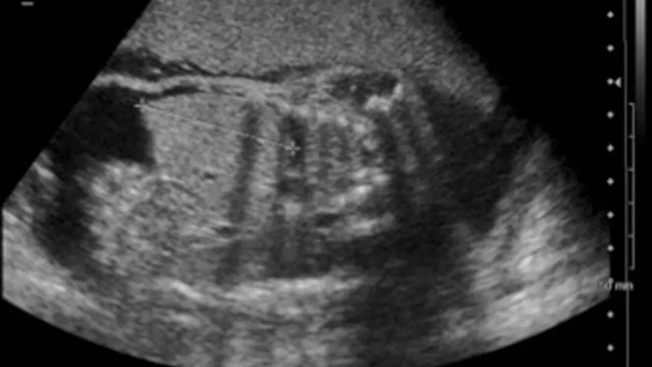 What happens to babies with congenital syphilis?