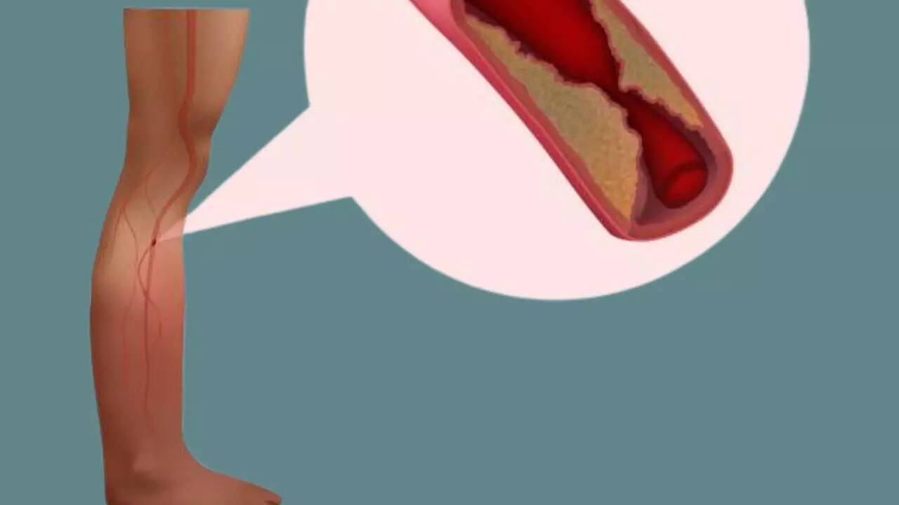 What are the symptoms of Peripheral Artery Disease?