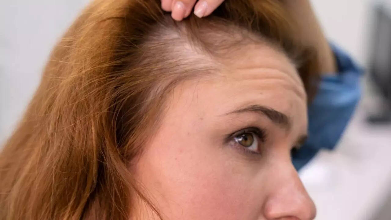 Hair loss (2)