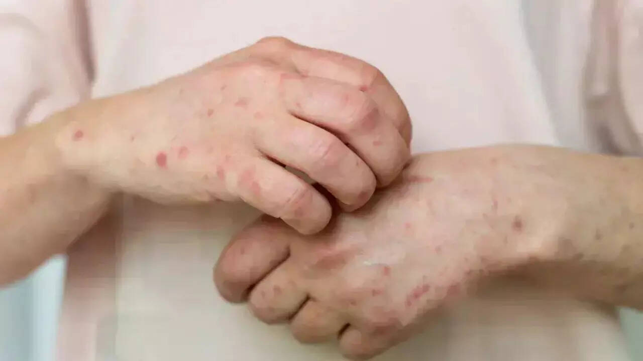 Valley fever (1)