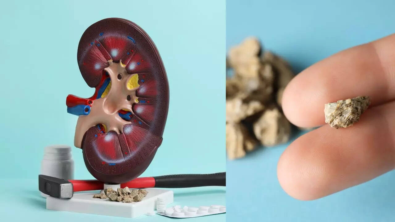 Kidney stone
