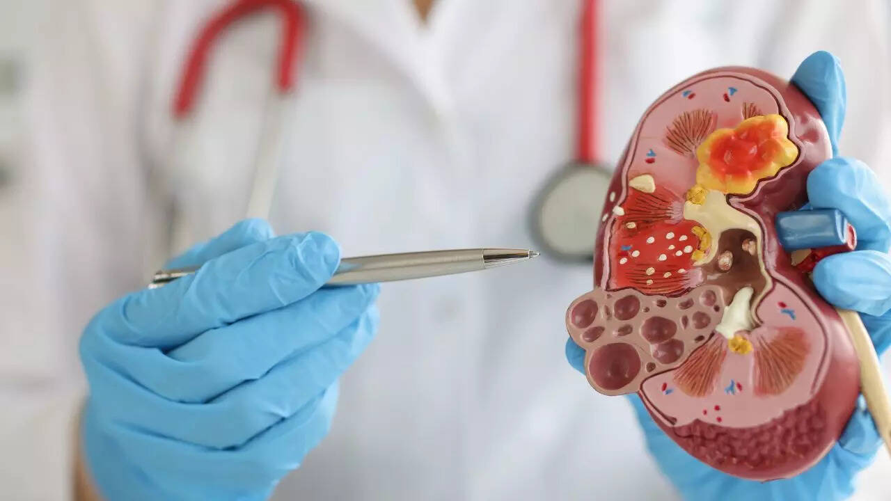 Kidney cancer
