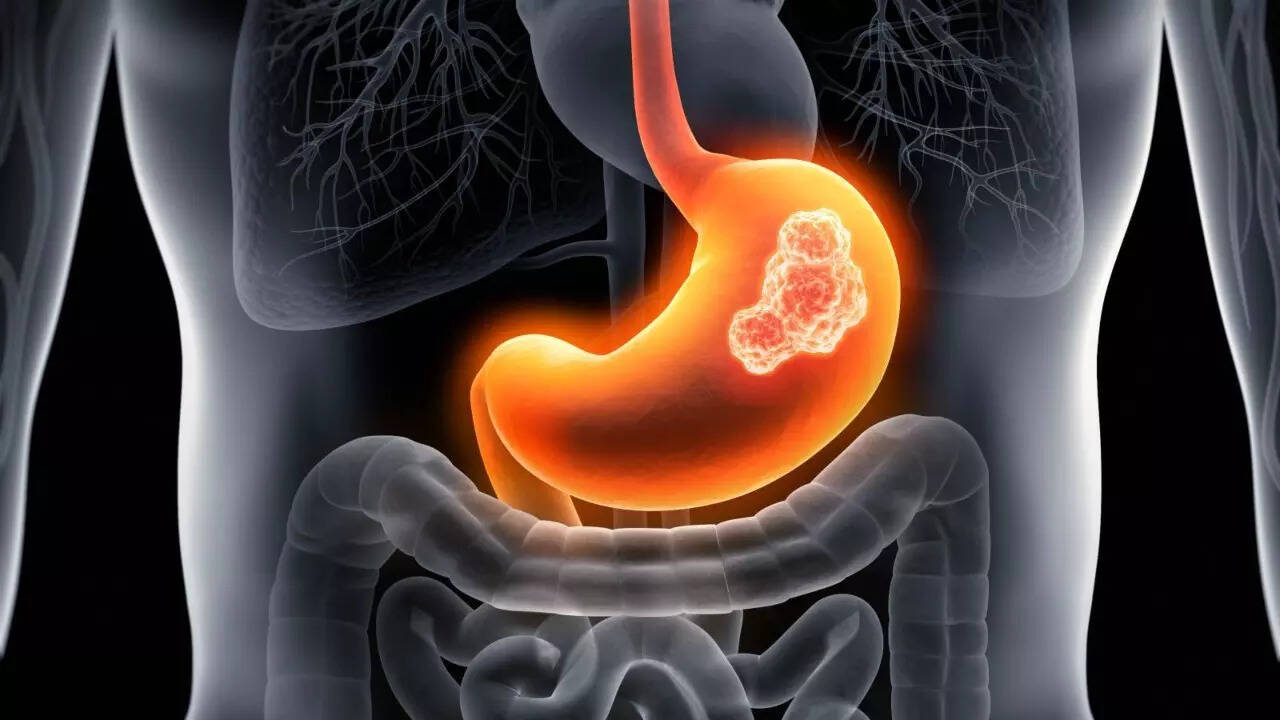 GI Cancer (5)