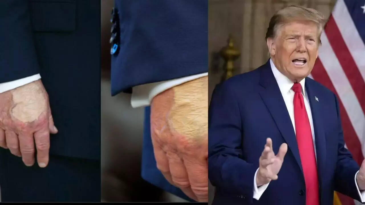 Trump spotted with hand makeup, swollen ankles; concerns over venous condition rise