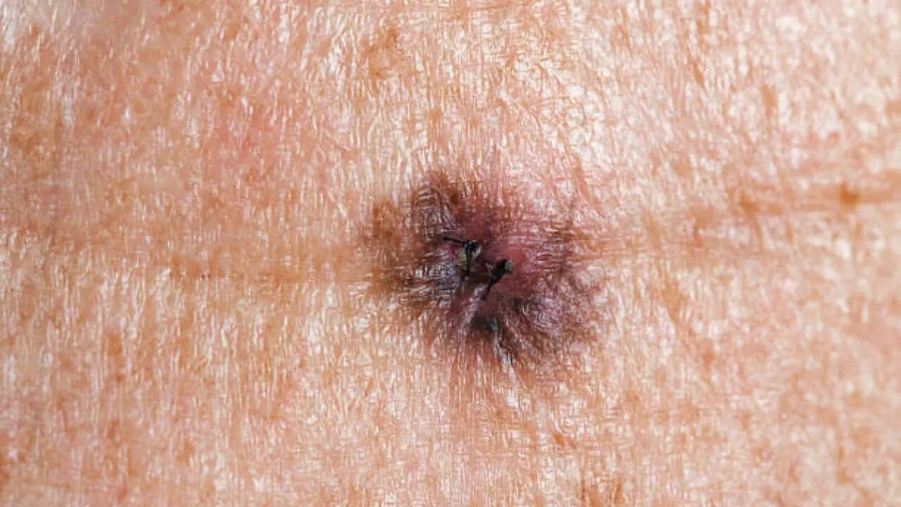 Types of skin cancer