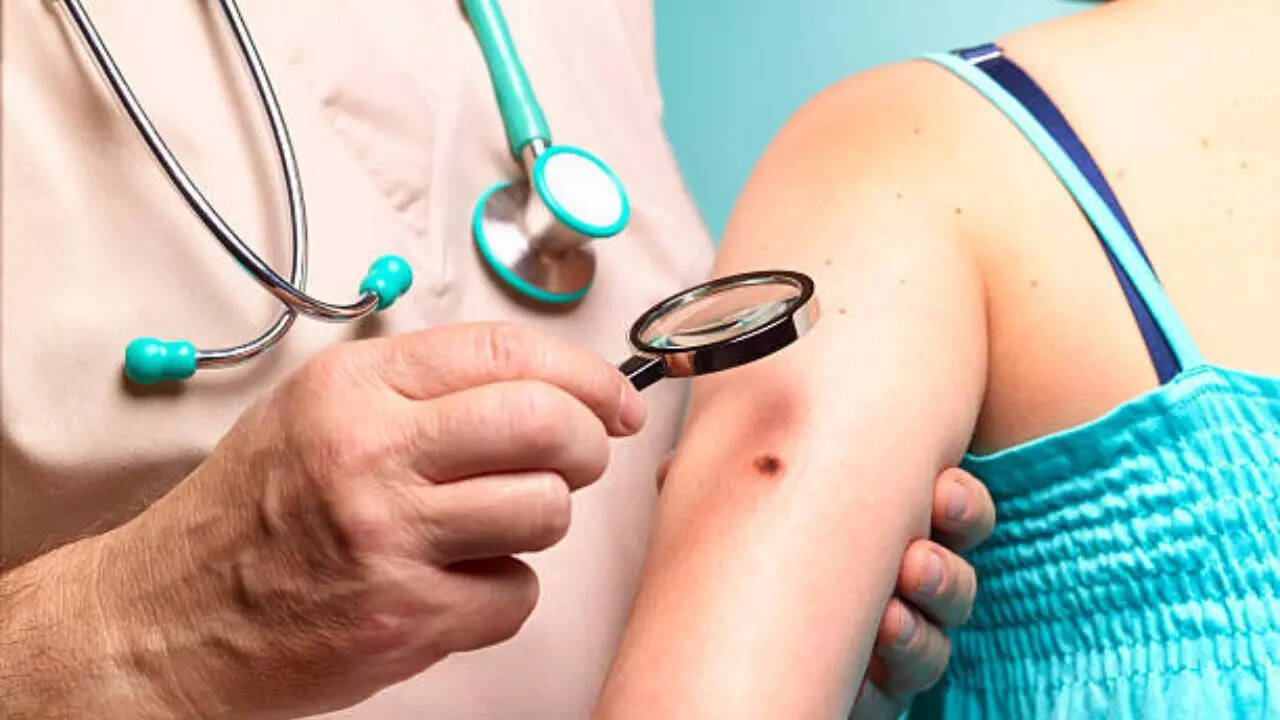 What are the signs of skin cancer?