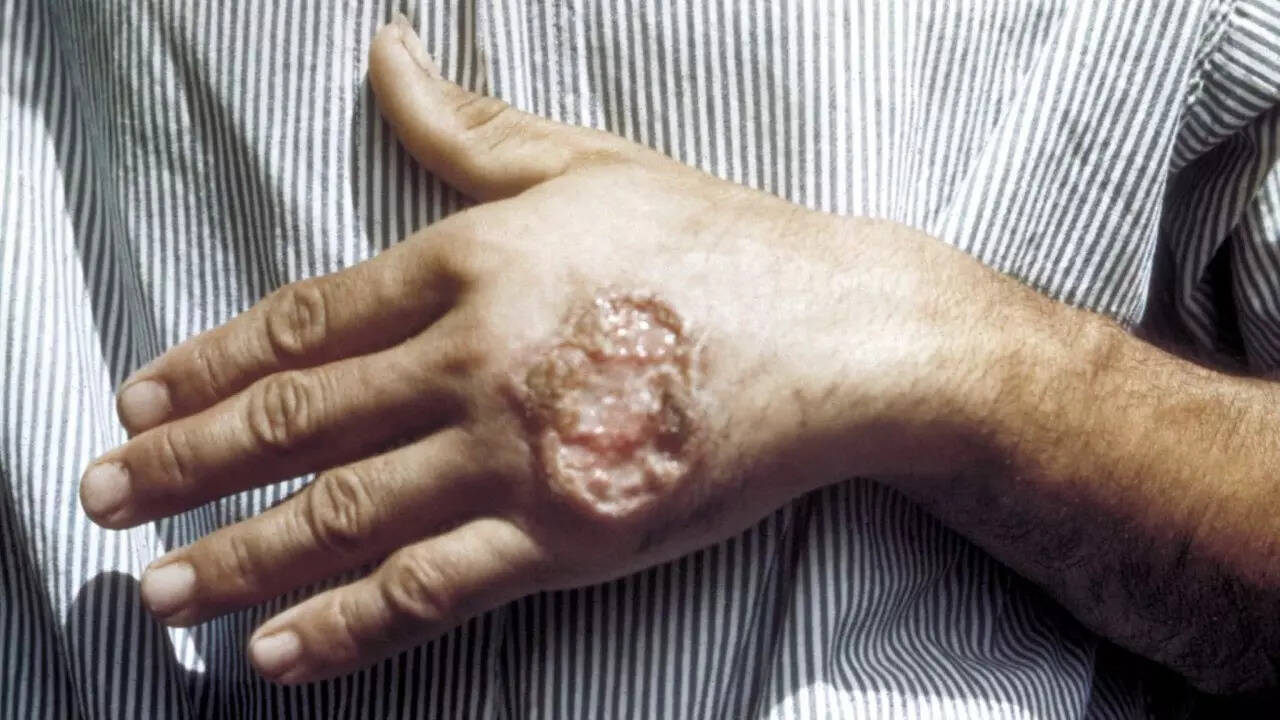 Flesh eating parasite (1)