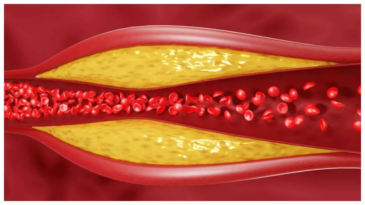 HDL vs LDL vs Triglycerides: How to optimally manage each form of Cholesterol