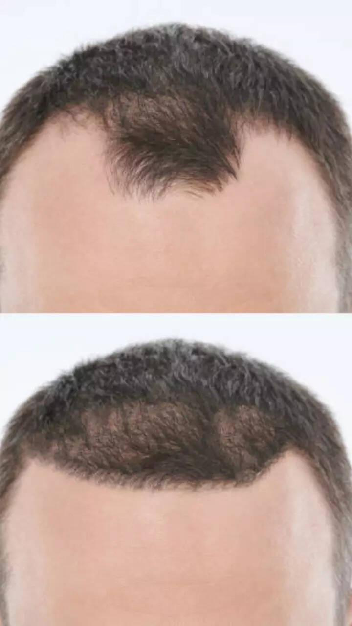 7 foods that can help prevent hair loss