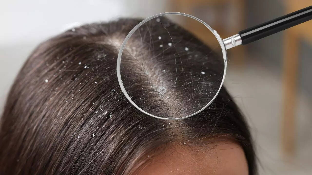 Dandruff