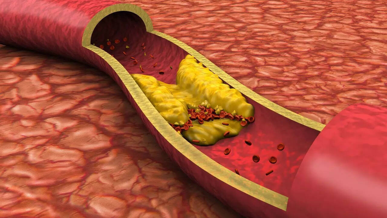 DEXA scan can identify Visceral fat