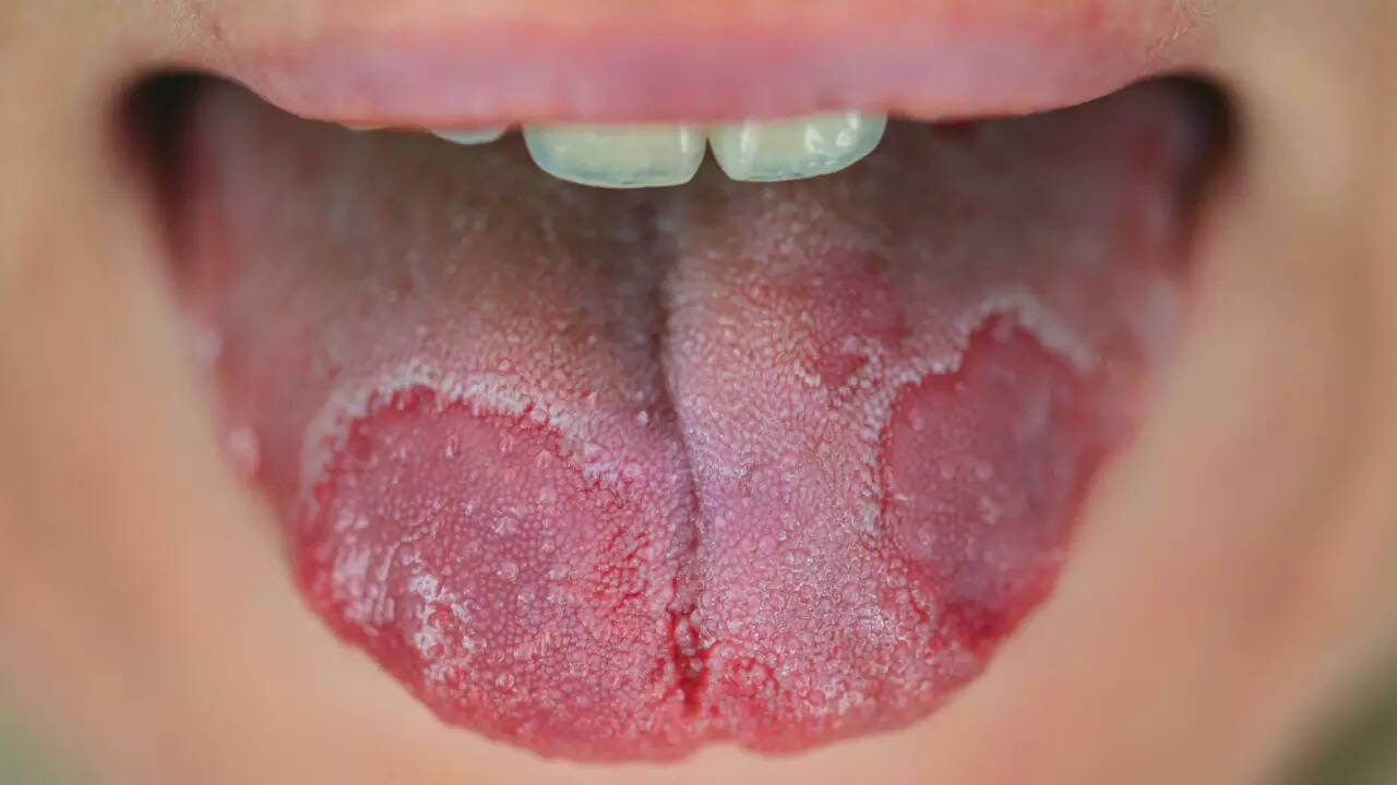 geographic tongue