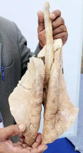 Regular smoker? COPD may affect even youth