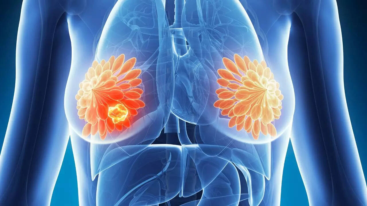 ​Can fibroids and fibroadenomas become cancerous?​ Credits: Canva