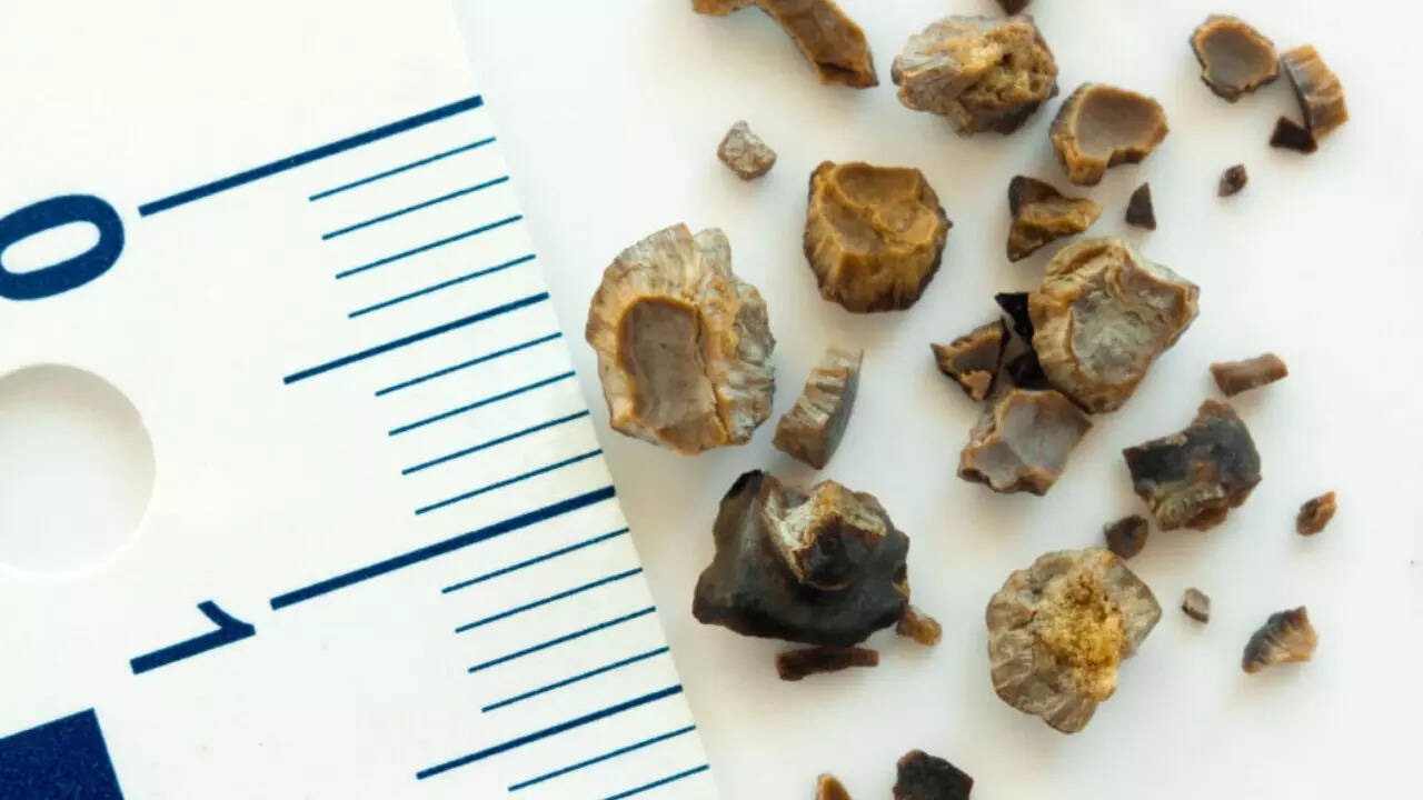 Kidney stones (2)