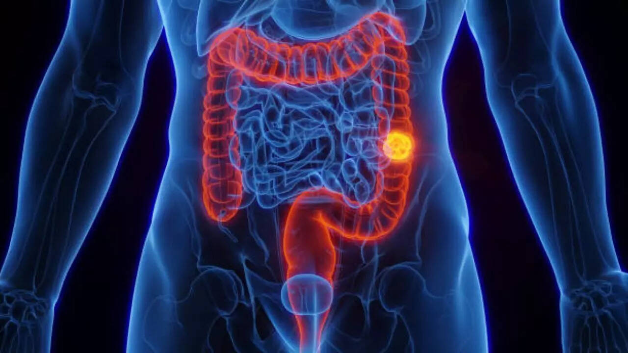 What is colorectal cancer?