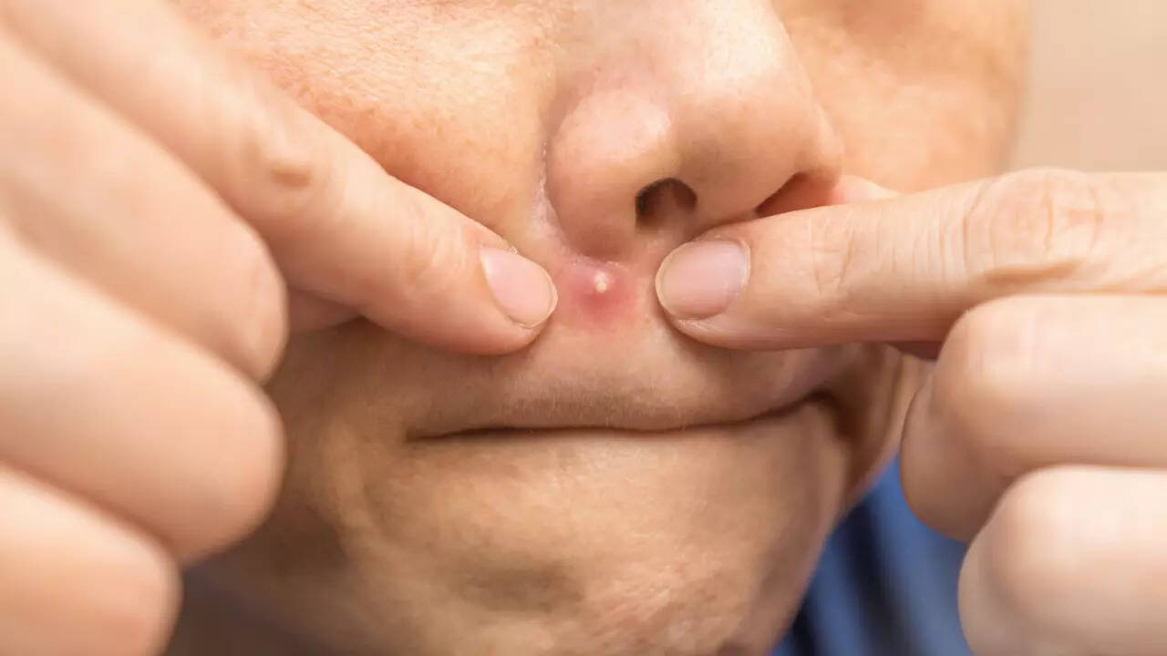 pimple
