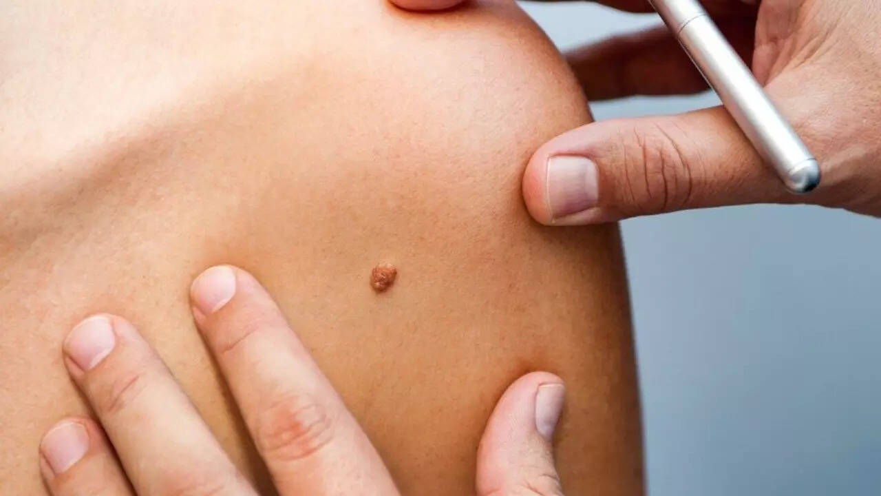 Skin Cancer (7)