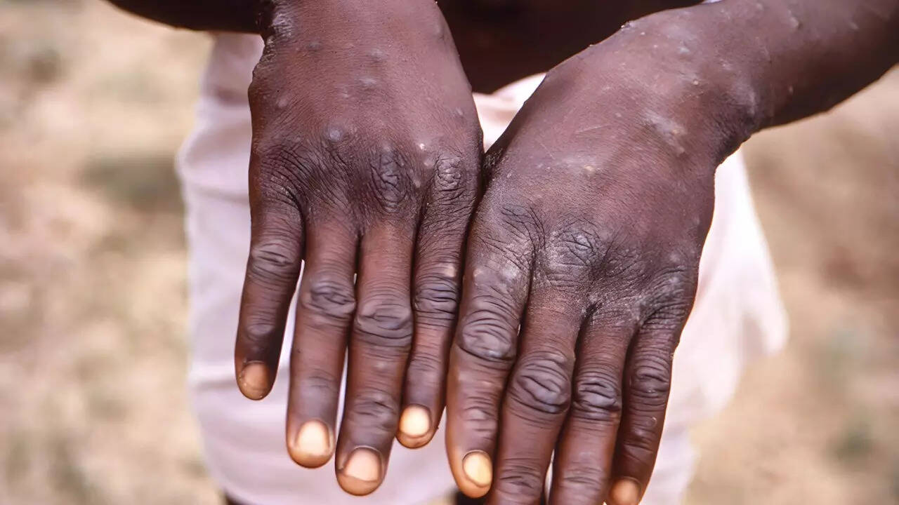 Mpox (1)