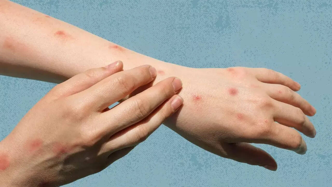Mpox (2)