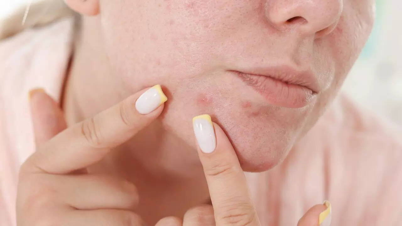 Laser treatments for removing acne scars