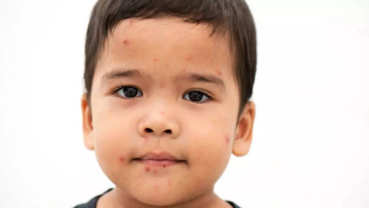 Childhood immunisation rates have dropped to their lowest