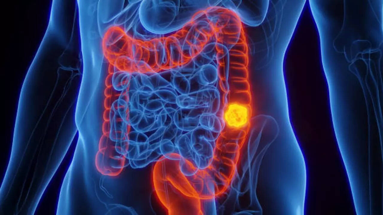 A shocking symptom of colon cancer