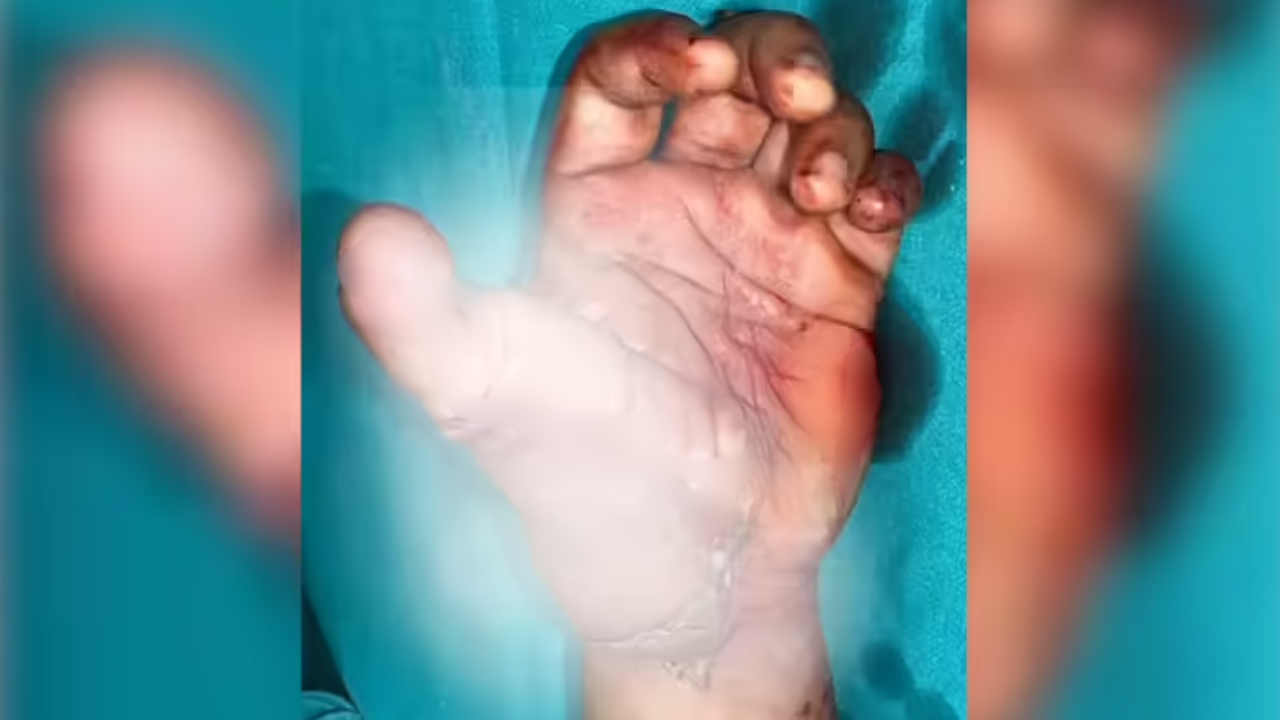 Remarkable surgery: Delhi surgeons use amputated toe to give Rewari youth new thumb