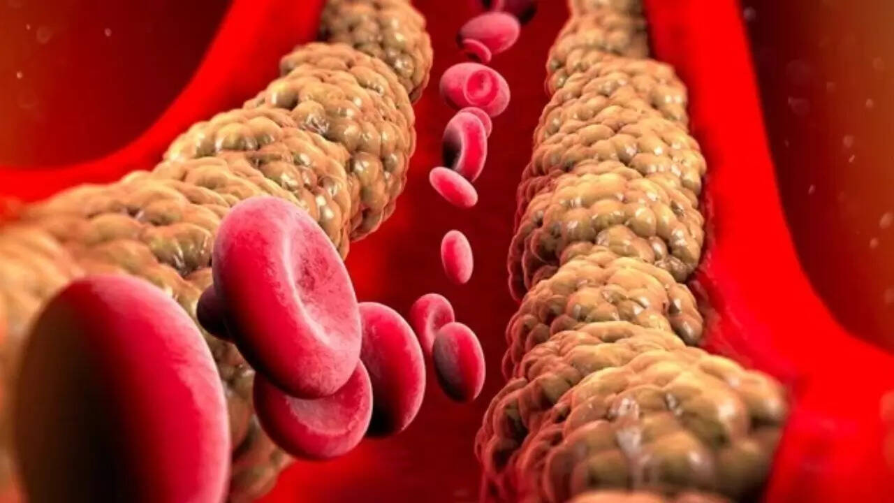Triglycerides (1)