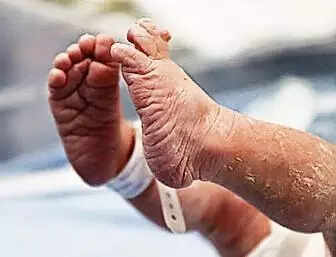 Neonatal experts boost hope for preterm infants