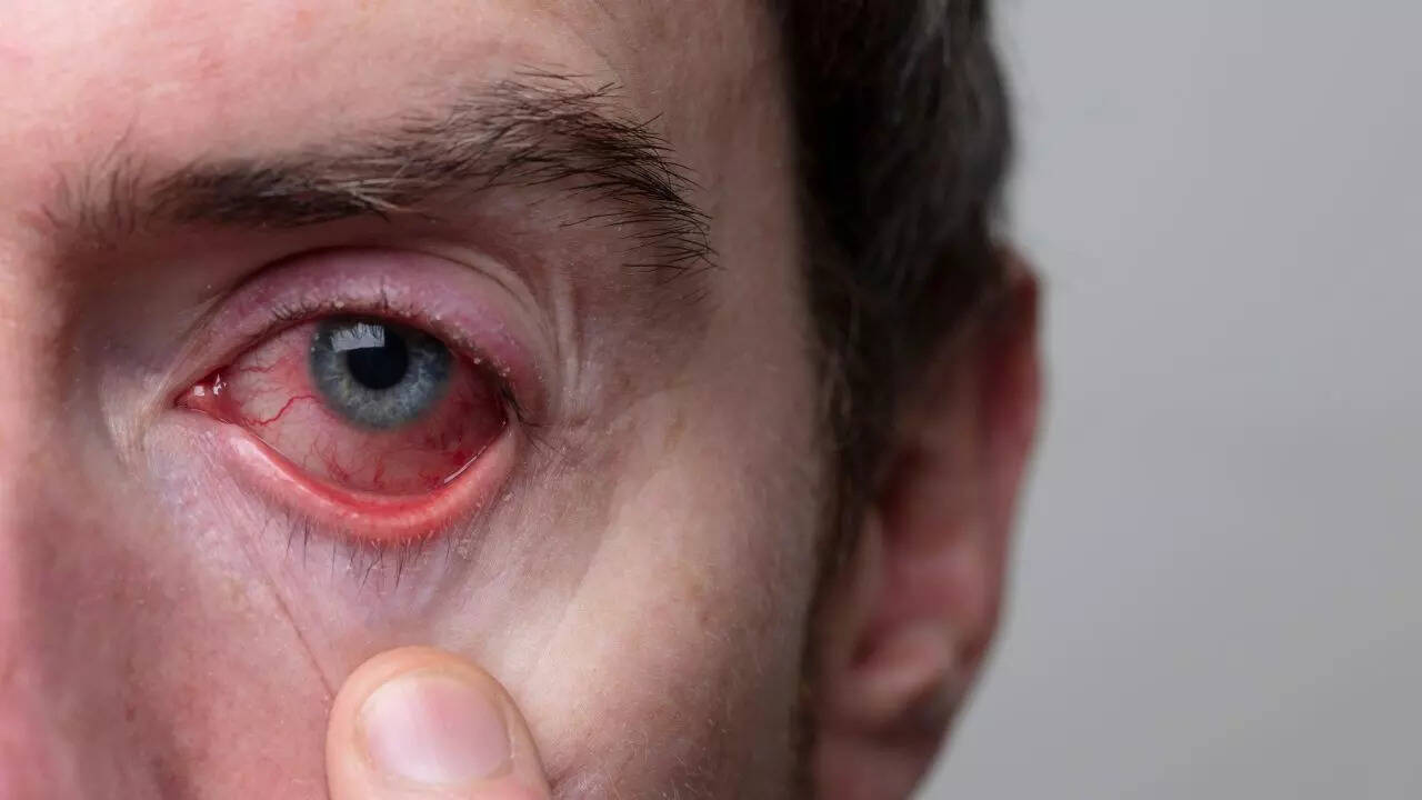 Burning, Gritty Eyes This Winter? Experts Say Delhi’s Indoor Heating May Be the Real Culprit