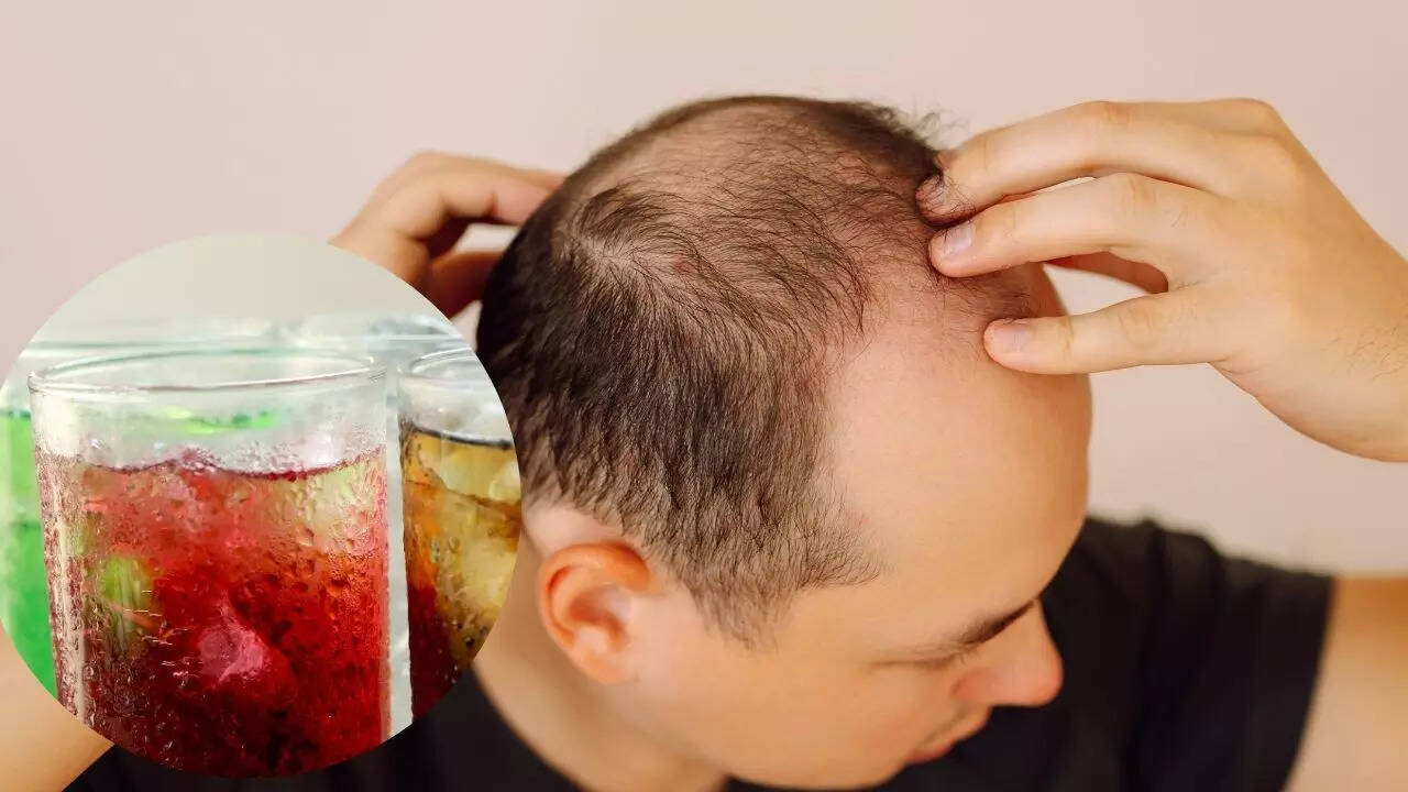 Your favourite soda could be silently causing hair loss and thinning: How sugar harms hair follicles