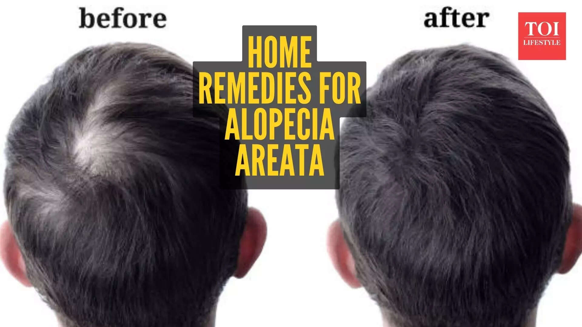 Alopecia Areata home remedies: 5 natural ways of reversing it