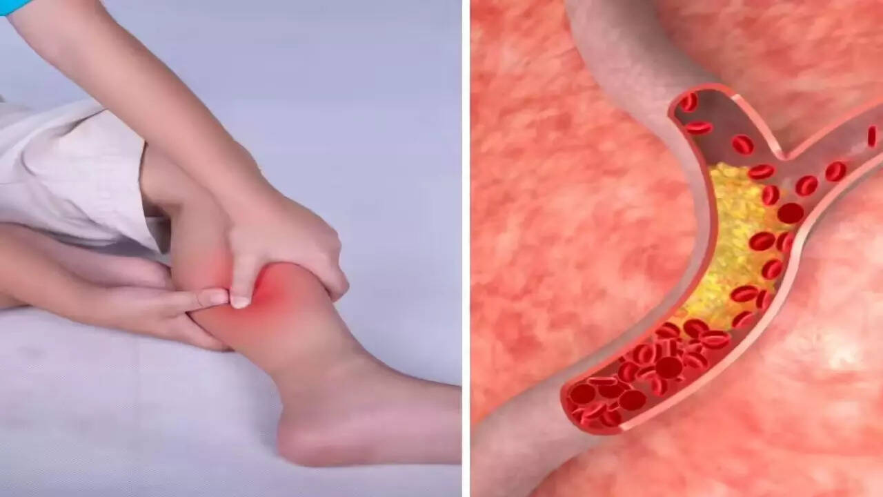 High cholesterol symptoms in legs at night: Warning signs you should never ignore