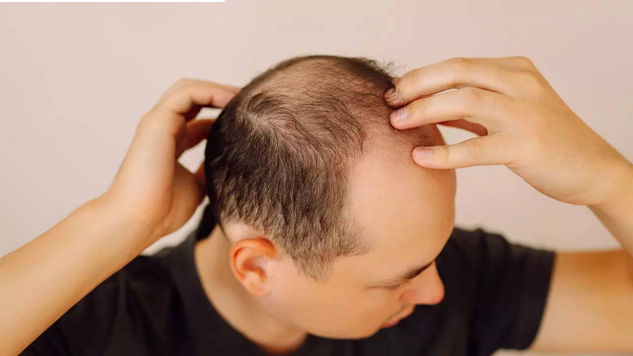 How an acne medicine may help reverse hair loss and baldness in males