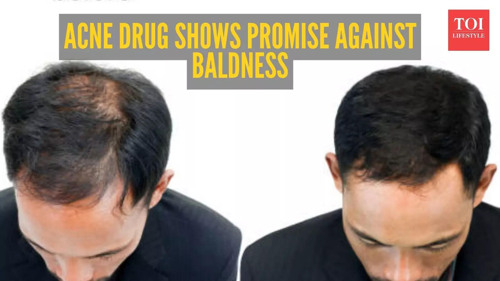 Common acne drug shows remarkable results in treating Male Pattern Baldness