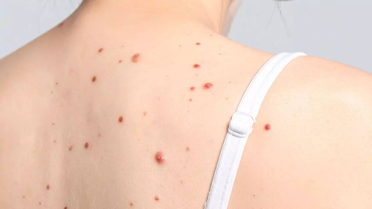 What those tiny red moles on your skin actually mean: Causes, risks and treatment options for cherry angiomas