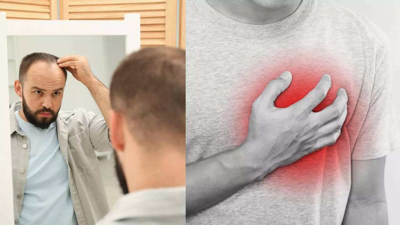 Severe hair loss in men may signal early heart problems: What new research reveals