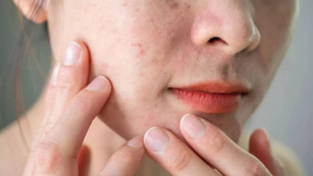 Acne